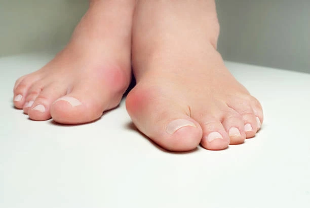 Foot infection